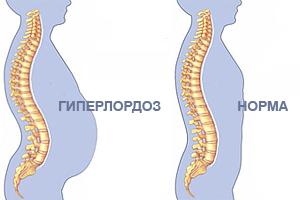 Гиперлордоз